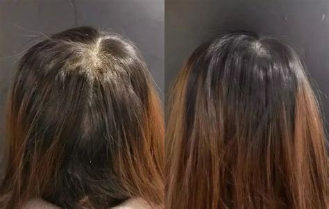 发缝越来越宽，不要担心，这个方法助你重新长出头发 - 知乎