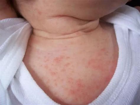 婴儿冬天捂热的疹子真实图片分享，身上有红点就要注意了_家庭医生在线