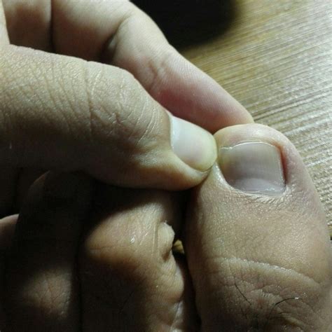 观察自己的手指甲，出现这种“竖条纹”，预示4种疾病可能出现了 - 知乎