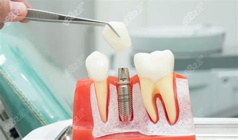 种植牙需要多长时间能种好？人工种植牙能用多少年？,种植牙-8682赴韩整形网