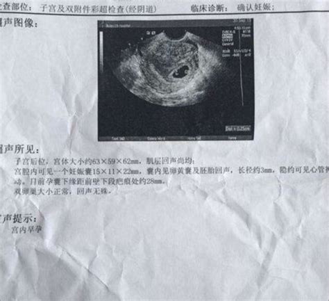 6一7周孕囊大小看男女，孕7周检查腹部B超，孕囊数据是29*16*33