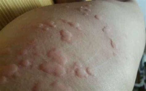 专家告诉你荨麻疹怎么预防-长春博润皮肤病医院