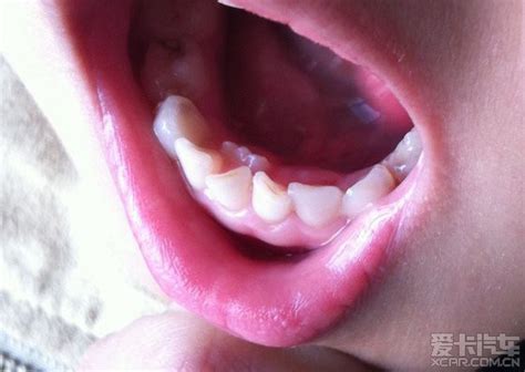 你的牙齿也有这些问题吗？ 需要及时矫正-海南口腔医院【官网】
