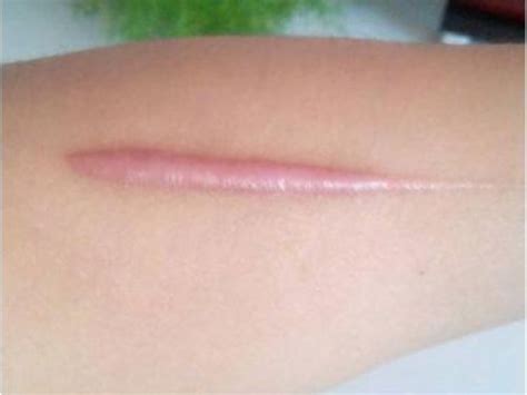 伤疤可以去除吗(皮肤上留了很久的疤，还能不能祛掉？) | 说明书网