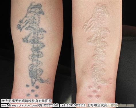 上海哪家正规医院洗纹身好的，价格多少左右？-上海哪家医院洗纹身比较好？