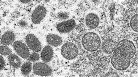 古巴发现首例猴痘病例 - 2022年8月21日, 俄罗斯卫星通讯社