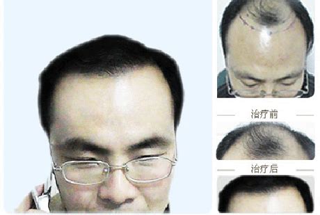 种植头发图片 种植头发图片对比(4)_配图网