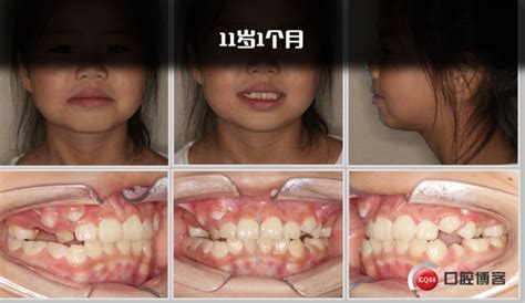 TOP1-乳牙期前牙反颌的正畸治疗-张世伟的博客-KQ88口腔博客