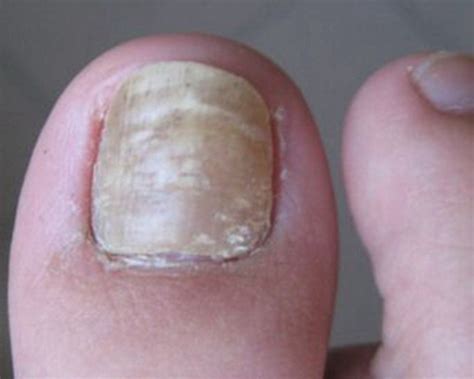 灰指甲相互传染，各甲之间传染是什么原因，中医如何辨证治疗？_凤凰网健康_凤凰网