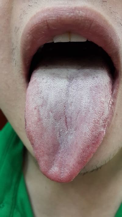 舌疾病图片_舌疾病症状表现图片大全_有来医生