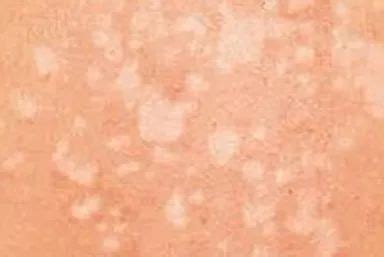 12种常见皮肤病分辨口诀 - 知乎
