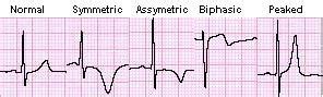 心室肥大，三种形态异常的QRS波不可忽视！ - 知乎