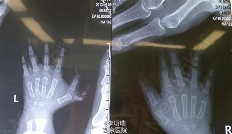 先天畸形：指骨及掌骨同时截骨矫形的多指切除术-医联