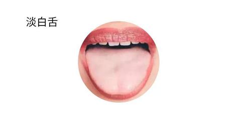 舌头有裂纹是怎么回事？裂纹舌简介|生活百科|奇说-红叶网