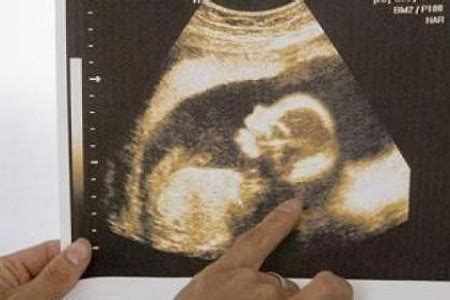 胎儿的性别预测，孕囊的形状看男女真的准吗|长和|孕囊|形状_新浪新闻