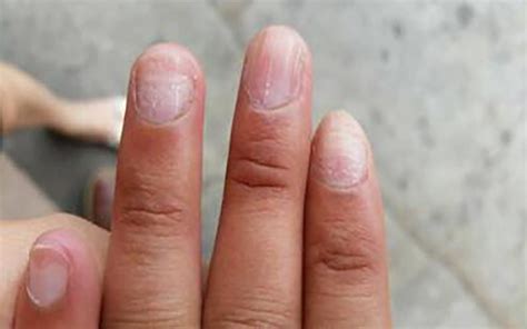 手上长灰指甲如何治疗，灰指甲完全痊愈大概需要多久？ - 知乎