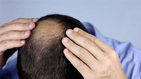 中华医学会 科普图文 植发可以用体毛或者别人的头发吗？这些常识你需要了解一下！