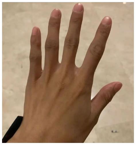 觉得自己手指太丑？心内科医生：可能是某些大病或者癌的信号哟|杵状指|疾病|手指_新浪新闻