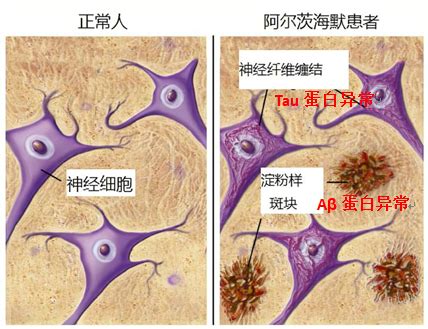 神经退行性疾病 | GeneTex中国官方网站