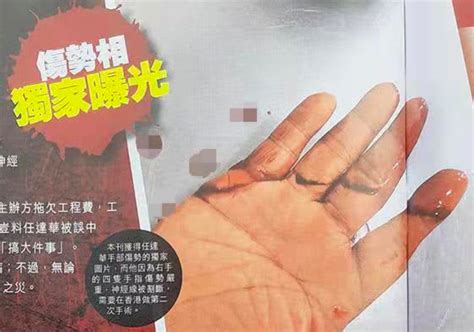 触目惊心！任达华右手伤势曝光，四只手指神经被割断-新闻中心-温州网