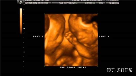 【高危妊娠那些事儿】 之 致双胞胎----如何理解双胎妊娠的绒毛膜性，请别走错房间！