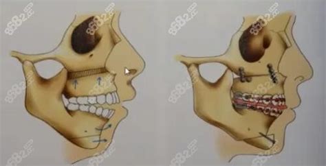 正颌手术过程图解正颌手术是怎么做的,看正颌手术风险大吗,颌面对比照-8682赴韩整形网