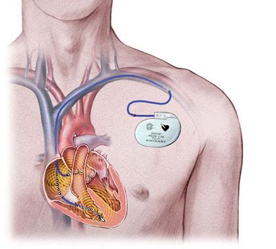 临时心脏起搏器安装图,类型,正常(第6页)_大山谷图库