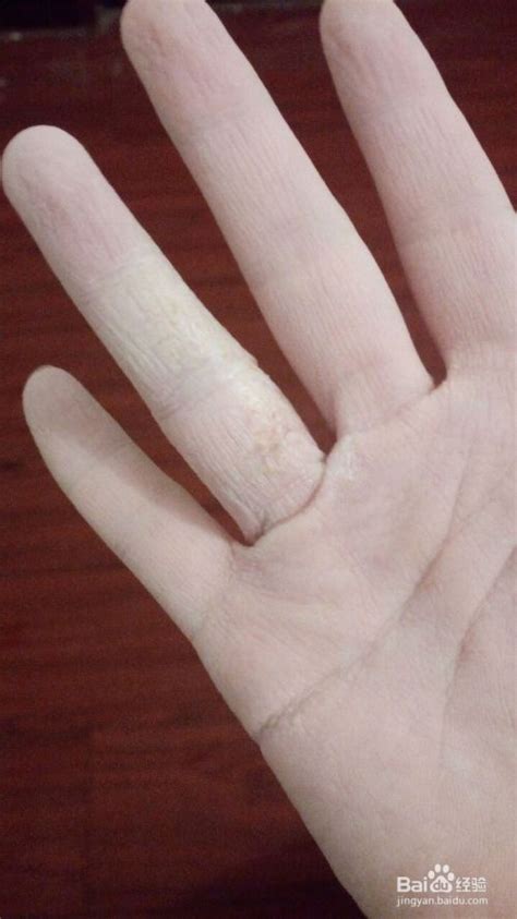 求诊症状：本人手指上长水泡，反复发作，会自愈。水泡透明的，针眼样的长满手指，中医看了说是湿疹。。。。_360问答