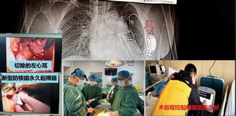 成都市新津区人民医院完成新津首例临时心脏起搏器植入术 - 滚动 - 华西都市网新闻频道