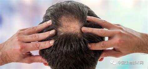 Cell子刊：科学家发现驱动毛发生长的关键信号分子，为治疗脱发带来新希望_风闻