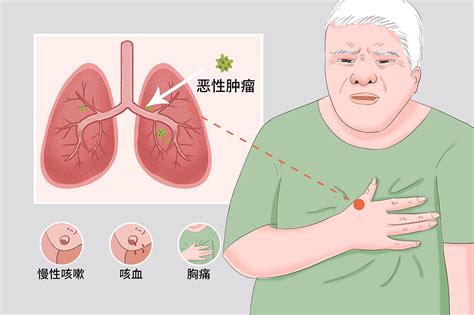 肺癌3个早期症状别忽视，很多人发现时已是晚期 - 知乎