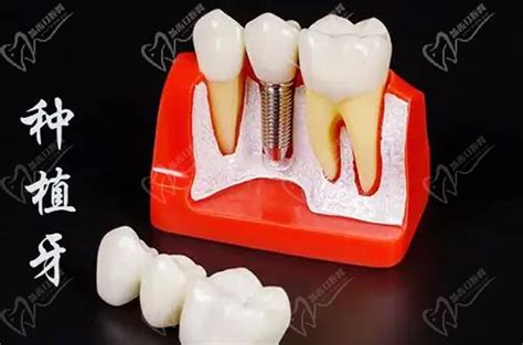 老人缺牙有三种修复方法:种植牙/固定义齿和活动假牙,+价格 - 口腔资讯 - 牙齿矫正网