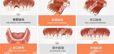吉安种植牙收费价格表：吉安种牙一颗5000起,三颗14000起,种植牙-8682赴韩整形网