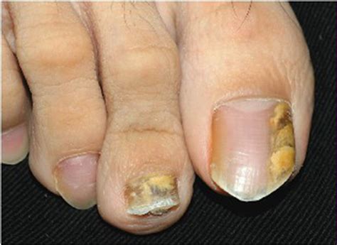 【灰指甲会传染吗】【图】告诉你灰指甲会传染吗 几个小方法让灰指甲远离你(2)_伊秀健康|yxlady.com