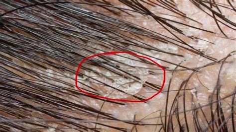 头皮屑对于头皮危害有多大？显微镜放大500倍，看完赶紧洗头！