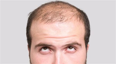 发际线种植和普通植发在操作上的区别:不同部位头发有差别 - 热点资讯 - 毛毛网