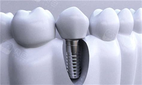 杭州牙科医院美国Zimmer种植牙集采7558元一颗,六家分店通用,种植牙-8682赴韩整形网