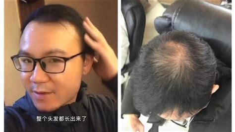 秃顶男子半月不用洗发水长出新头发 专家紧急提醒_凤凰网