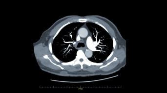 CTA胸部与造影剂轴向MIP视图用于诊断肺栓塞_(PE)_和肺癌。_3840X2160_高清视频素材下载(编号:16858853)_全部_光厂 ...