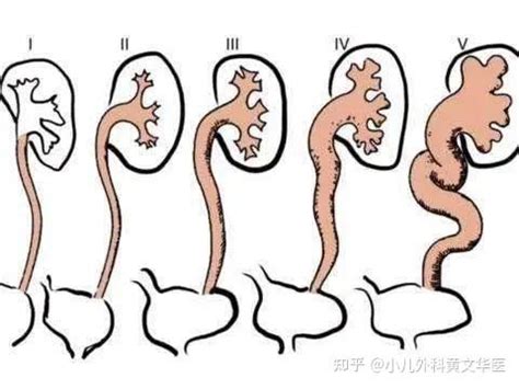 三维3d医学动画制作《经尿道前列腺气囊扩张导管术》手术仿真演示动画片-黄鹤楼动漫动画片设计制作公司