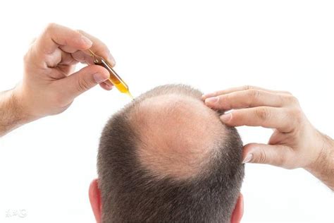 治愈脱发最新重大突破，美研究出DHKE基因治疗脱发