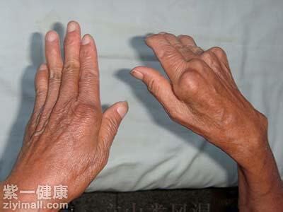 【专题】手指关节肿大变形_健康经验