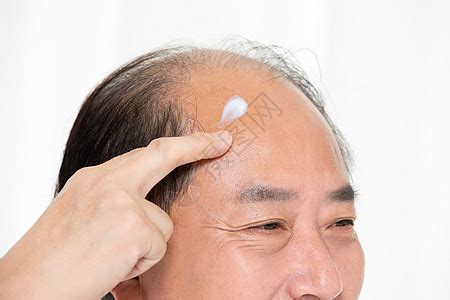科学家发现防秃的新方法 - 俄罗斯卫星通讯社