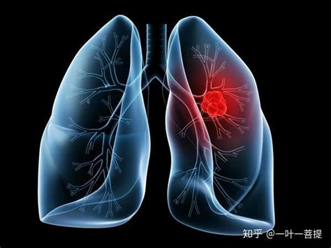 得了肺癌该怎么治？治疗方案要从类型、分期、身体状况综合考虑-肺癌