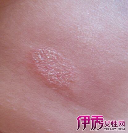 皮肤癣是什么原因导致的_皮肤癣_北京京城皮肤医院(北京医保定点机构)