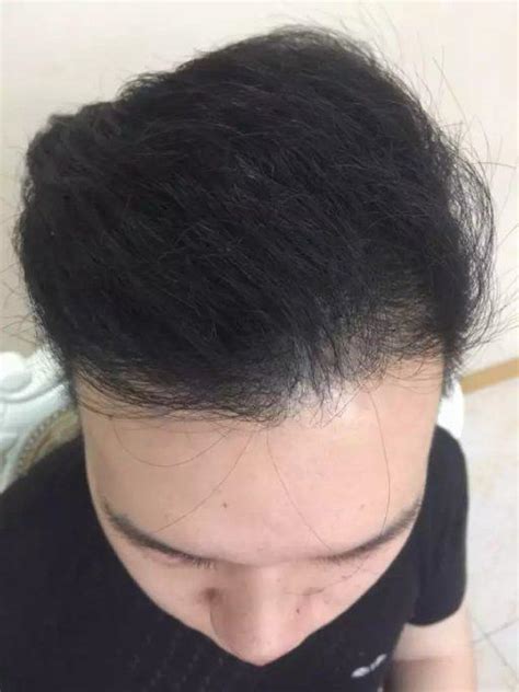 科普：男性植发大概需要多少钱？还有术后能维持多久呢？,毛发整形对比照-8682赴韩整形网