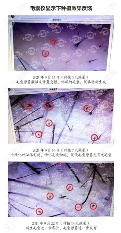 万众期待的HBW毛囊克隆技术，正式落地北京 | 中国周刊