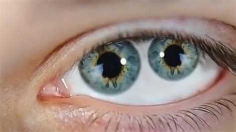 历史上的重瞳子是真实存在的吗？两个瞳仁在眼睛里是如何分布的？ - 知乎