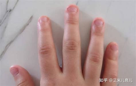 10岁男童啃指甲的坏处,小孩咬指甲有什么方法戒除?