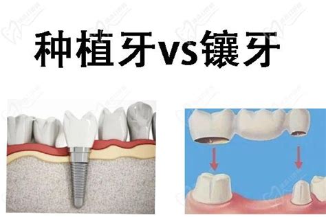 图3-65 下颌乳中切牙-基础医学-医学